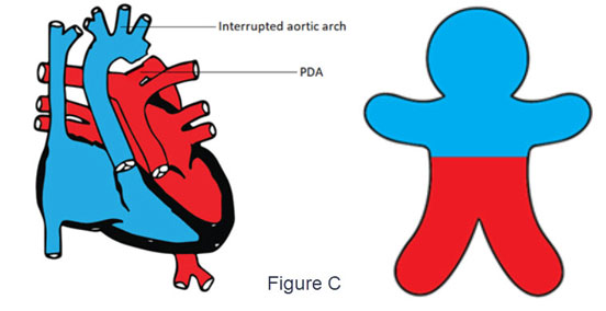 Interrupted aortic arch