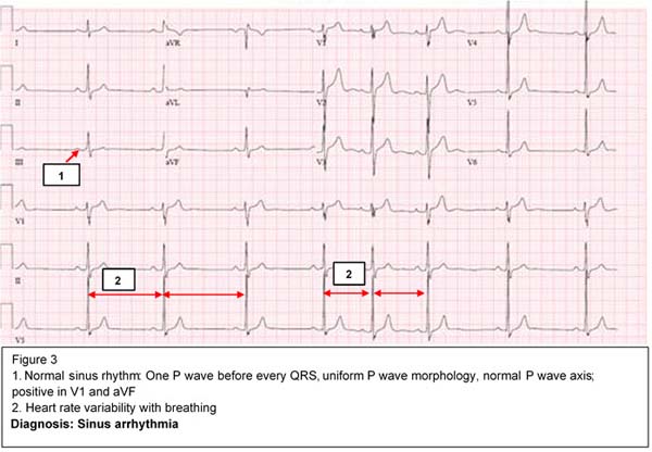 Diagnosis: Sinus Arrhythmia