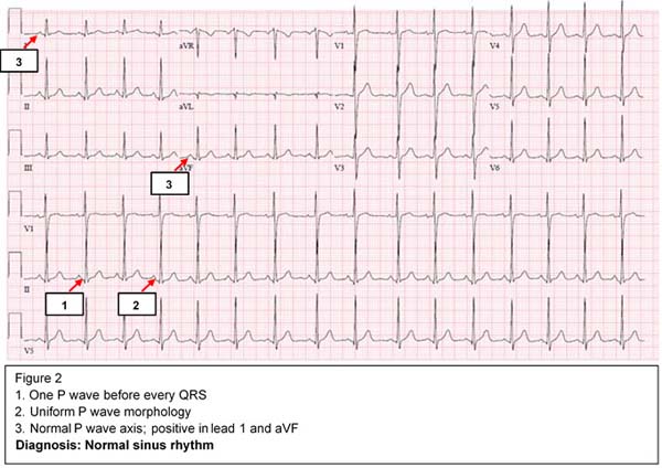 Diagnosis:Normal Sinus Rythm