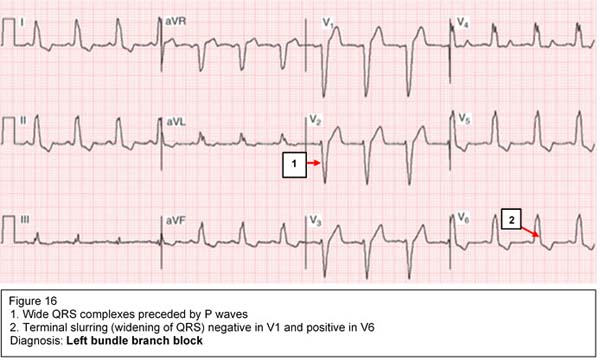 Diagnosis: Left bundle branch block