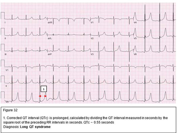 Syndrome Du Qt Long Intervention QGMHTP