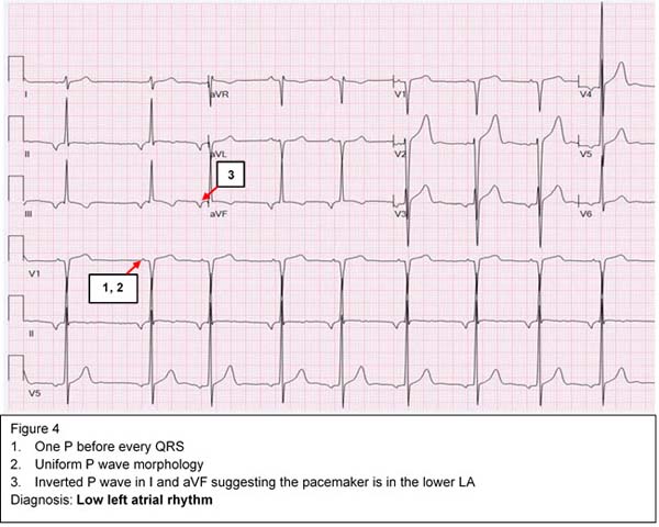 Diagnosis: Low Left Atrial Rhythm