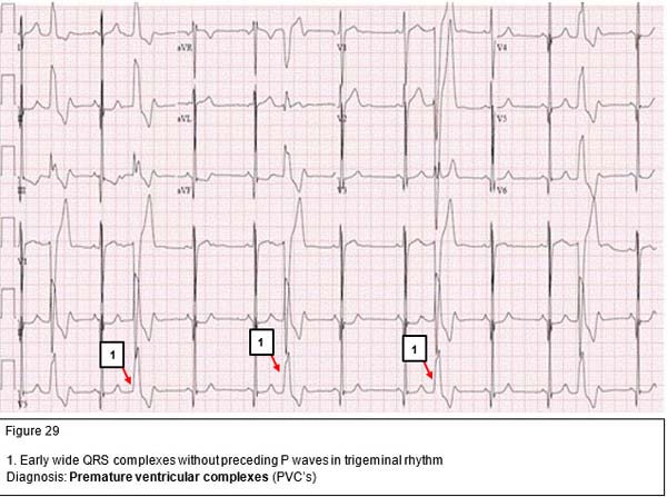 Diagnosis: Premature ventricular complexes (PVC’s)