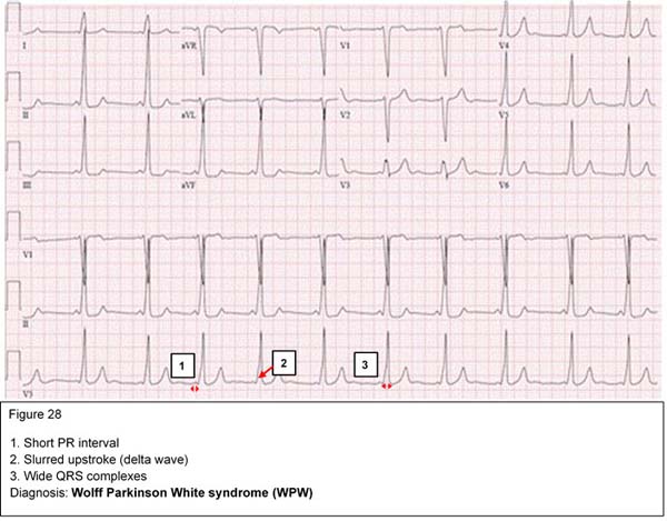 Diagnosis: Wolff Parkinson White syndrome (WPW)