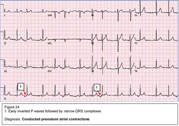 Magnésium : e-cardiogram