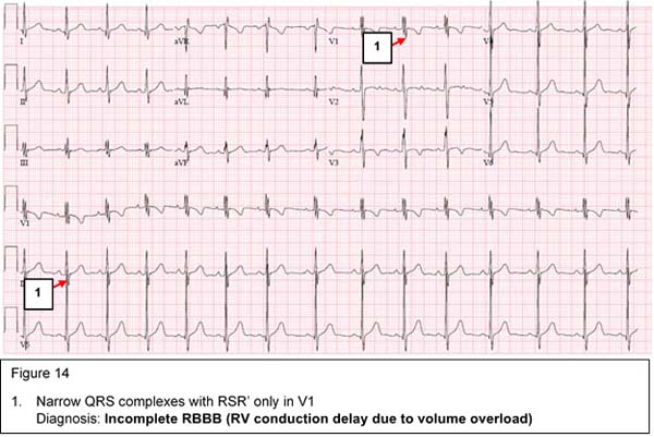 Diagnosis: Incomplete RBBB (RV conduction delay due to volume overload)