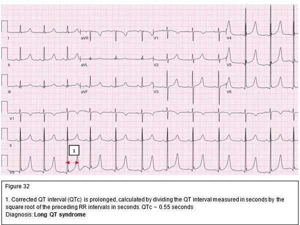 Diagnosis: Long QT syndrome