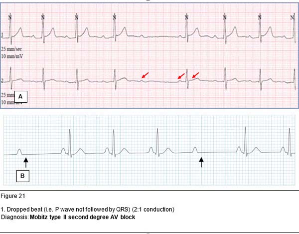 Diagnosis: Mobitz type II second degree AV block