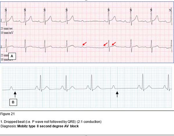 Diagnosis: Mobitz type II second degree AV block