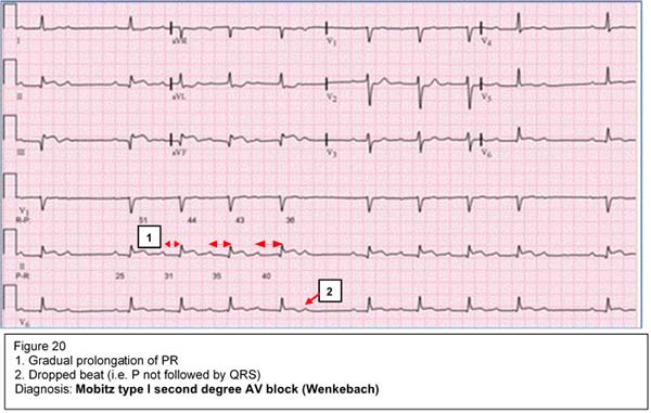 Mobitz type I second degree AV block (Wenkebach)