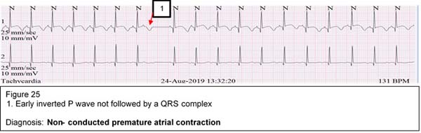 Diagnosis: Non- conducted premature atrial contraction