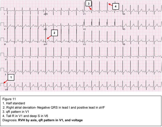 Diagnosis: RVH by axis, qR pattern in V1, and voltage criteria