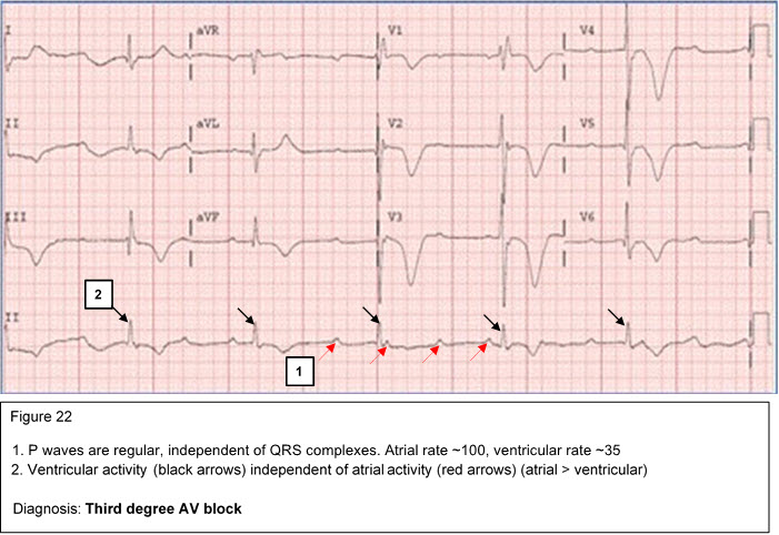 Diagnosis: Third degree AV block