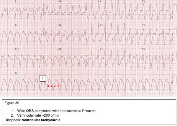 Diagnosis: Ventricular tachycardia