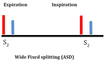 Wide Fixed Splitting (ASD)