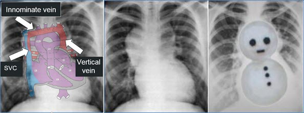 Cyanotic Cardiac Lesions