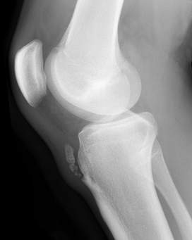 http://www.radpod.org/2008/03/25/osgood-schlatter-disease/