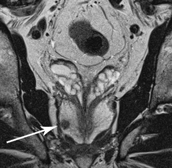 MRI of prostate cancer.