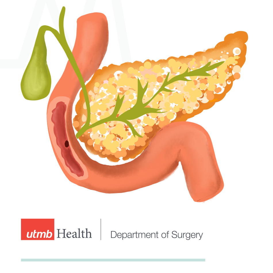 Pancreas and gallbladder illustration with UTMB Surgery logo