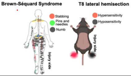 A diagram illustrates Brown-Séquard syndrome from a T8 spinal cord hemisection with sensory changes shown in a human figure and rodent model.