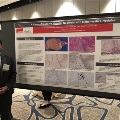 UTMB pathology resident standing next to a research poster titled “A Case of Massive Hepatic Necrosis with Regenerative Nodules,” showing histology images and clinical findings at a conference.