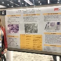 UTMB pathology resident standing beside a research poster on anaplastic thyroid carcinoma, featuring cytology images and study findings, displayed at a medical conference poster session.