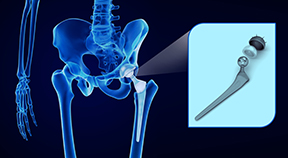 Arthroplasty Arthroplasty