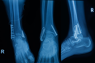 Foot and Ankle surgery