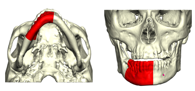 Computer-generated image of a jaw needing repair