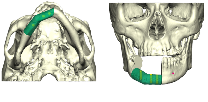 Computer generated image of jaw section needing repair