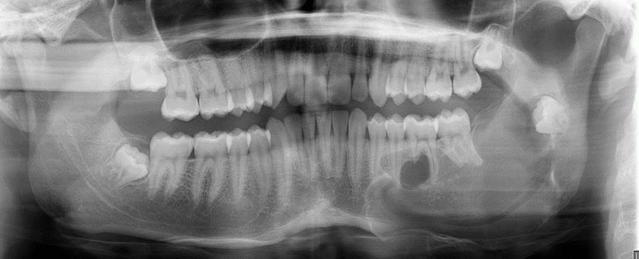 Xray image of jaw