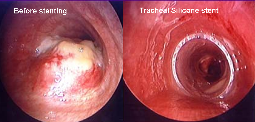 Tracheal Squamous Cancer before stenting and after