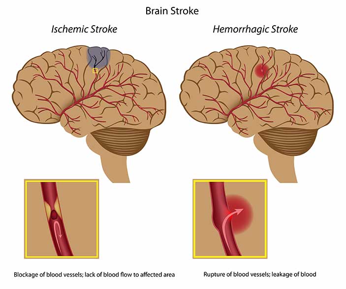 Image of Brain Stroke Types and the Brain