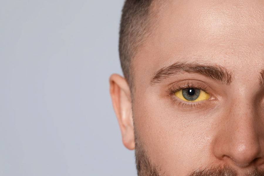 Closeup of man’s eyes with yellow sclera