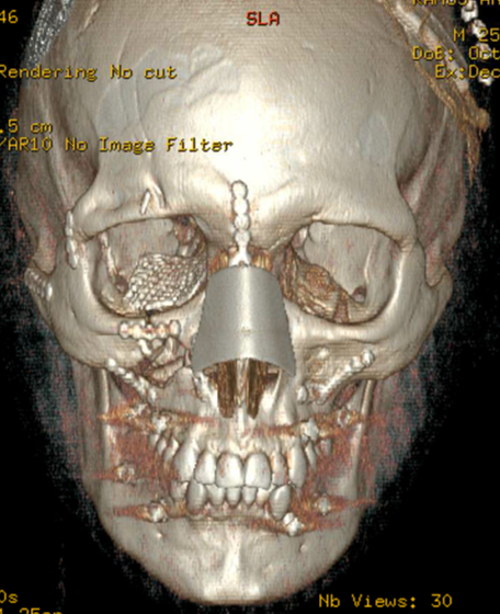 Skull after facial reconstruction
