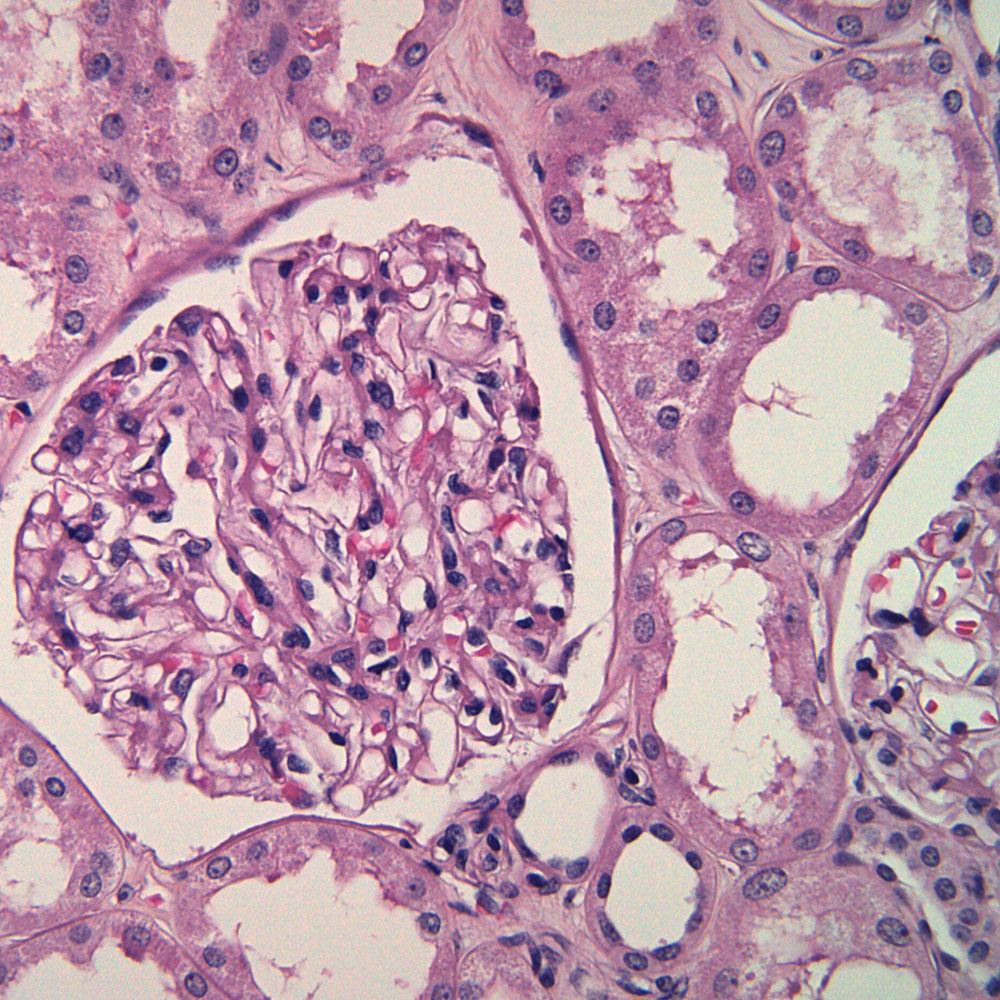 Kidney biopsy showing a normal glomerulus composed of thin capillaries. The surrounding tissue is filled with renal tubules. Microscopic view.