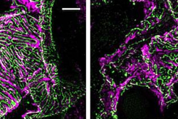 Podocin/a-Actinin-4, comparison of 2 microscopic views, control on left, 2019-nCov on right
