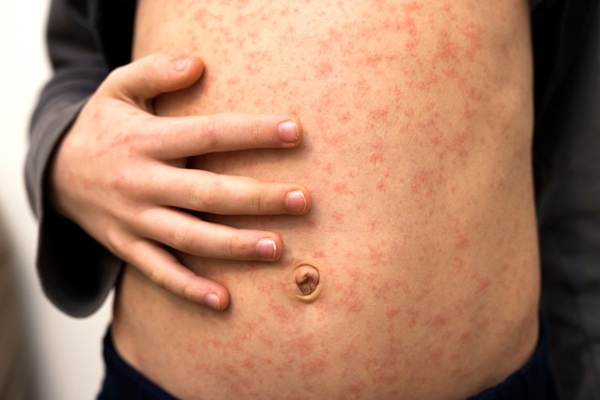 Measles on stomach
