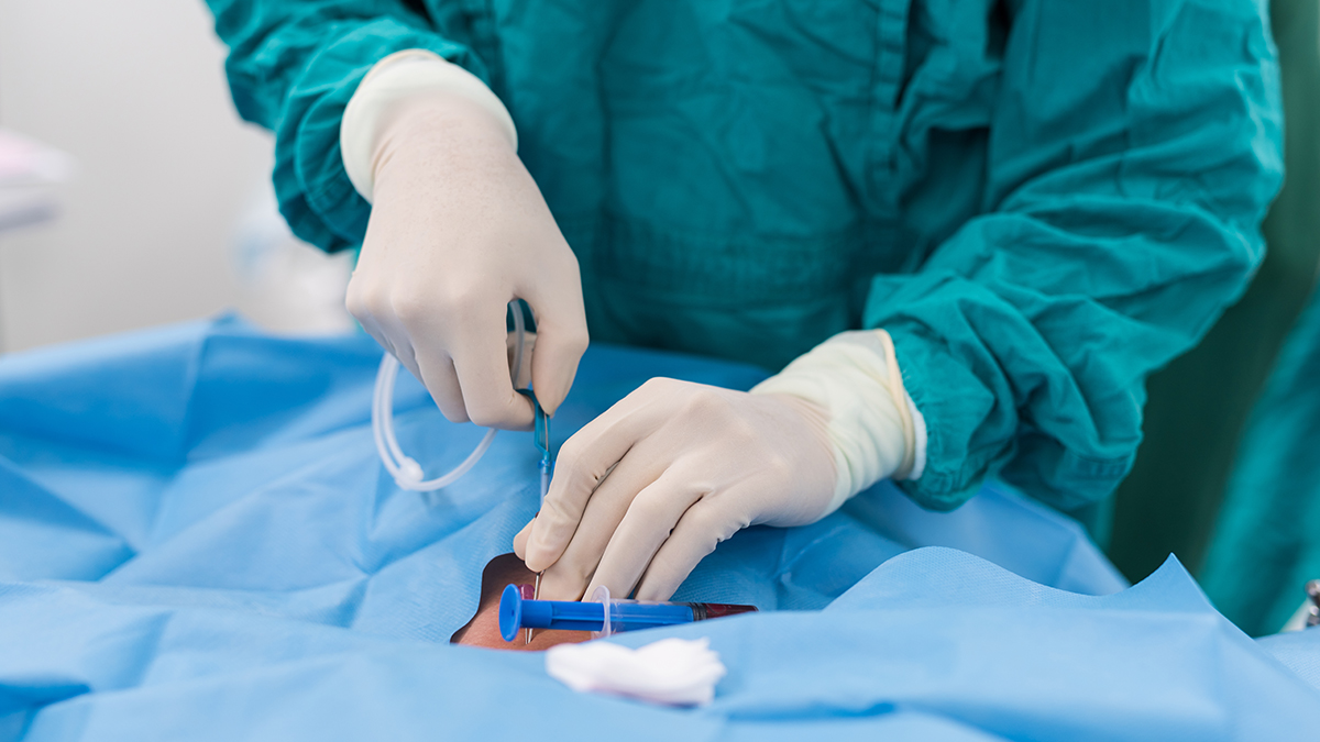 A surgeon's hands are seen as they are applying a guide wire to an internal carotid vein.