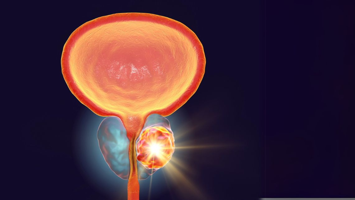 Illustrated image of the prostate showing a highlighted area that represents prostate cancer