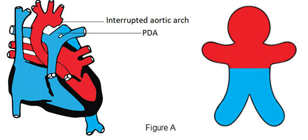 Interrupted aortic arch