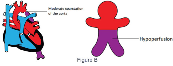 Moderate coarctation of the aorta