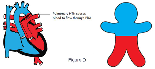 Pulmonary HTN causes blood to flow through PDA