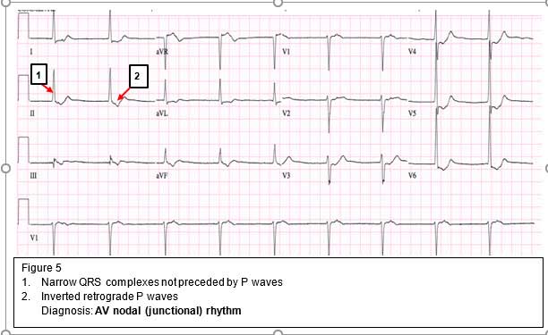 Diagnosis: AV nodal (junctional) rhythm