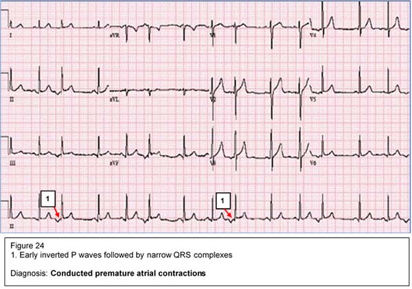 Diagnosis: Conducted premature atrial contractions