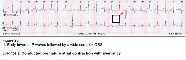 Diagnosis: Conducted premature atrial contraction with aberrancy