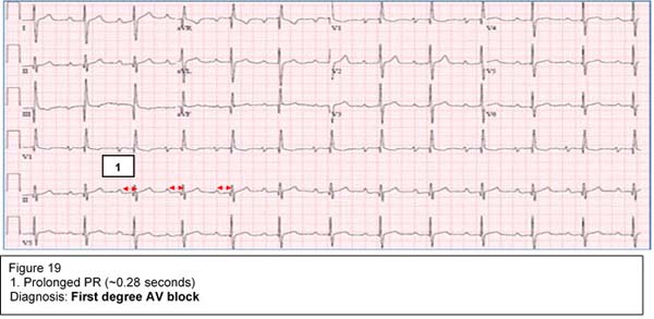 Diagnosis: First degree AV block