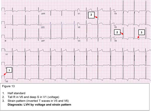 Diagnosis: LVH by voltage and strain pattern