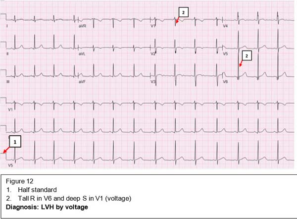 Diagnosis: LVH by voltage