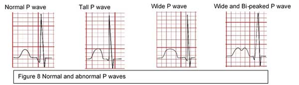 Normal and abnormal P waves